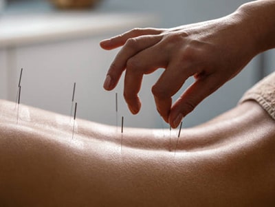 Acupunctură